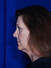 Facelift Before & After