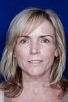 Facelift Before & After