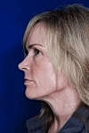 Facelift Before & After