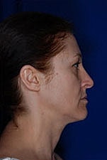 Facelift Before & After