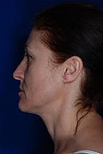 Facelift Before & After