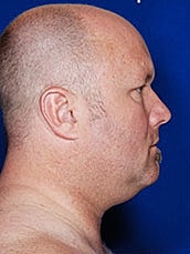 Facelift Before & After
