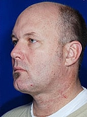 Facelift Before & After