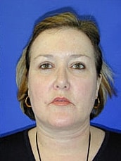 Facelift Before & After