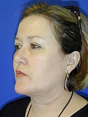 Facelift Before & After