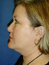 Facelift Before & After