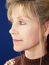 Facelift Before & After
