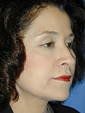 Facelift Before & After