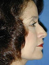 Facelift Before & After