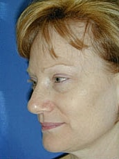 Facelift Before & After