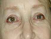 Facelift Before & After