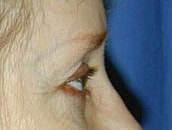 Facelift Before & After