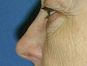 Facelift Before & After