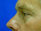 Facelift Before & After
