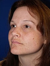 Facelift Before & After