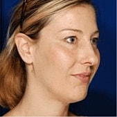 Facelift Before & After