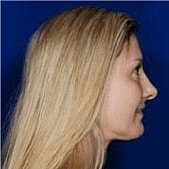 Facelift Before & After