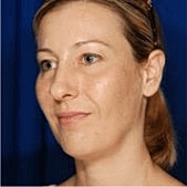 Facelift Before & After