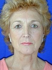 Facelift Before & After