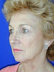 Facelift Before & After