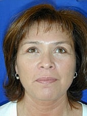 Facelift Before & After