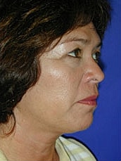Facelift Before & After