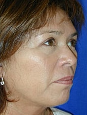 Facelift Before & After