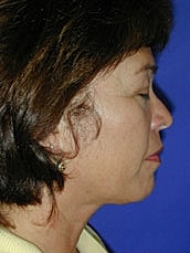 Facelift Before & After