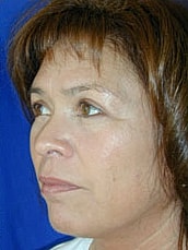 Facelift Before & After