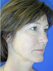 Facelift Before & After