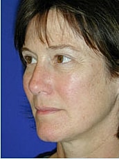 Facelift Before & After
