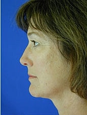 Facelift Before & After