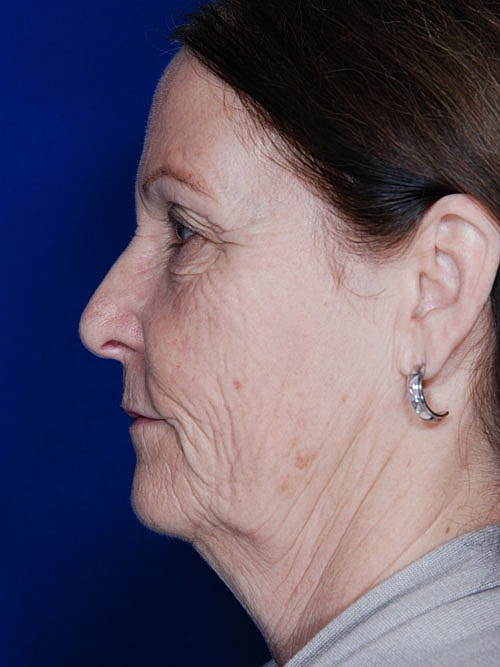 Facelift Before & After