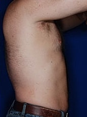Male Liposuction Before & After
