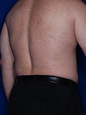 Male Liposuction Before & After