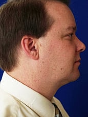 Male Liposuction Before & After