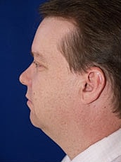 Male Liposuction Before & After