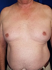 Male Liposuction Before & After
