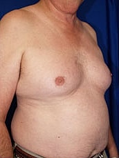 Male Liposuction Before & After