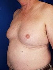 Male Liposuction Before & After