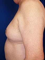 Male Liposuction Before & After