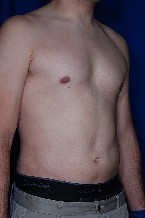 Male Liposuction Before & After