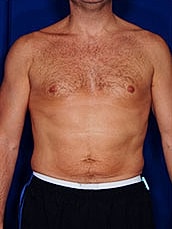 Male Liposuction Before & After