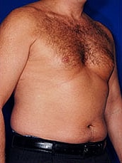 Male Liposuction Before & After