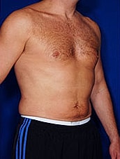 Male Liposuction Before & After