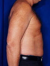 Male Liposuction Before & After