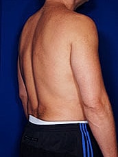 Male Liposuction Before & After