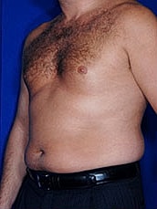 Male Liposuction Before & After