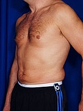 Male Liposuction Before & After