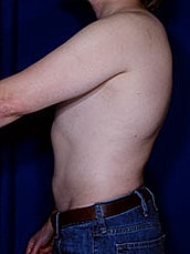 Male Liposuction Before & After
